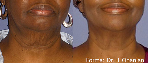 Before and After Photos of Renouveau Med Spa in Los Angeles, CA