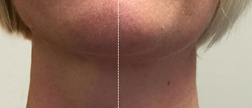 Before and After Photos of Renouveau Med Spa in Los Angeles, CA