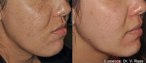 Before and After Photos of Renouveau Med Spa in Los Angeles, CA