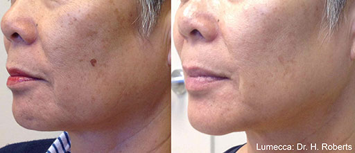 Before and After Photos of Renouveau Med Spa in Los Angeles, CA