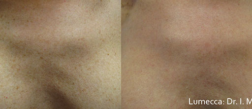 Before and After Photos of Renouveau Med Spa in Los Angeles, CA