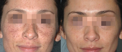 Before and After Photos of Renouveau Med Spa in Los Angeles, CA