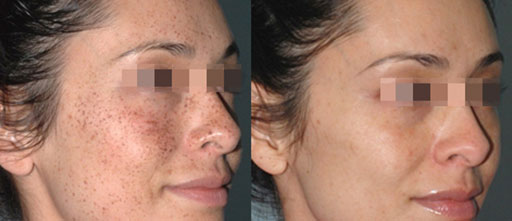 Before and After Photos of Renouveau Med Spa in Los Angeles, CA