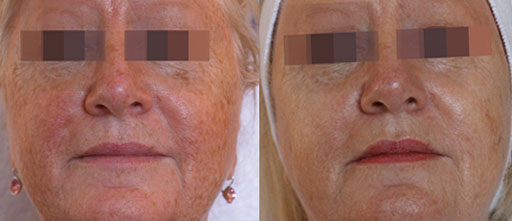 Before and After Photos of Renouveau Med Spa in Los Angeles, CA