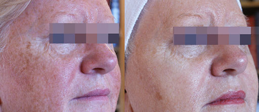 Before and After Photos of Renouveau Med Spa in Los Angeles, CA