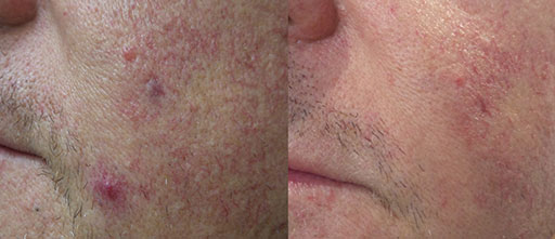 Before and After Photos of Renouveau Med Spa in Los Angeles, CA