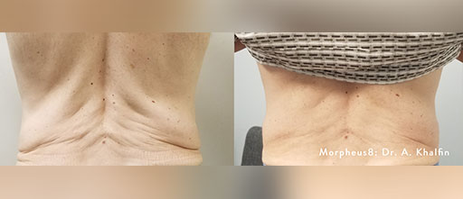 Before and After Photos of Renouveau Med Spa in Los Angeles, CA