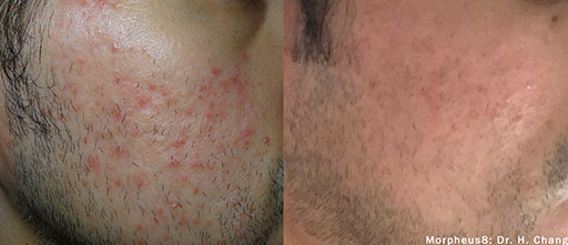 Before and After Photos of Renouveau Med Spa in Los Angeles, CA