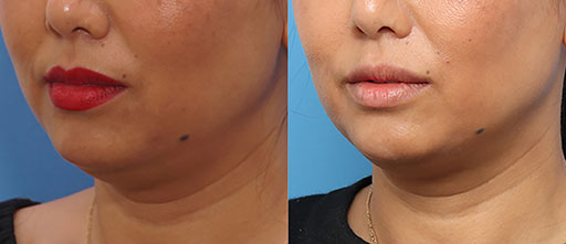 Before and After Photos of Renouveau Med Spa in Los Angeles, CA