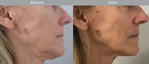 Before and After Photos of Renouveau Med Spa in Los Angeles, CA