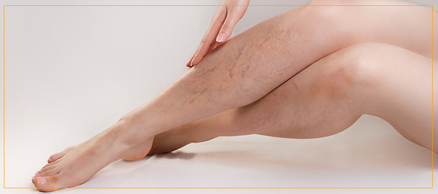 Vasculaze Vein Treatment Near Me in Culver City Los Angeles CA