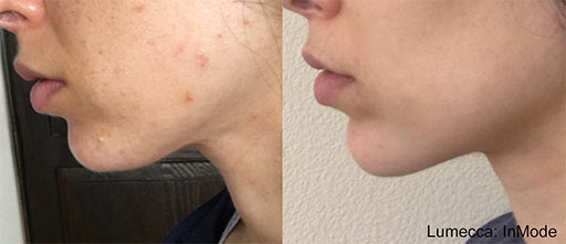 Before and After Photos of Renouveau Med Spa in Los Angeles, CA