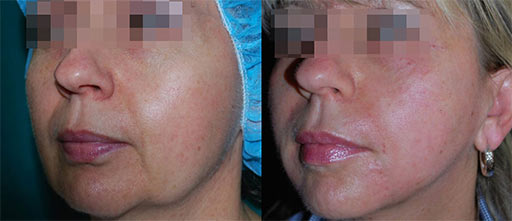 Before and After Photos of Renouveau Med Spa in Los Angeles, CA