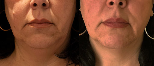 Before and After Photos of Renouveau Med Spa in Los Angeles, CA