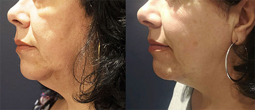 Before and After Photos of Renouveau Med Spa in Los Angeles, CA