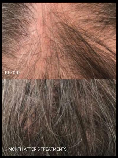 Before and After Photos of Renouveau Med Spa in Los Angeles, CA