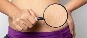 Stretch Mark Removal Treatment Near Me in Mar Vista Los Angeles CA