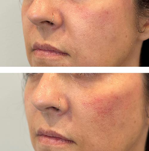 Before and After Photos of Renouveau Med Spa in Los Angeles, CA